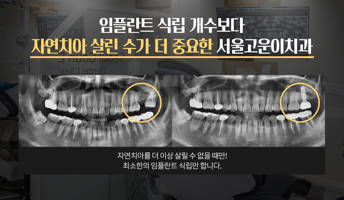 자연치아 수복 우선