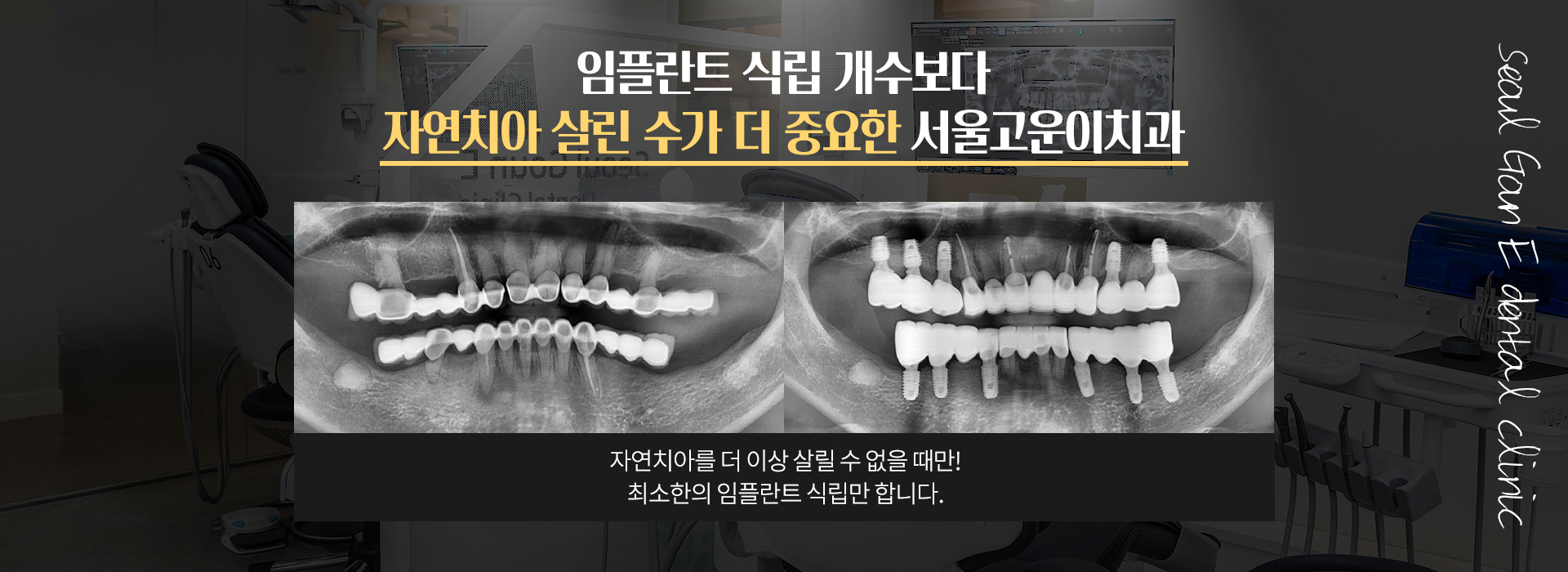 자연치아 수복 우선