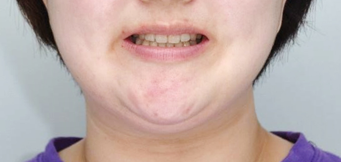 후