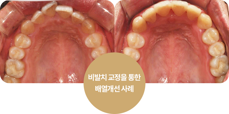 사례