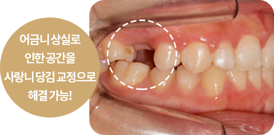 사례